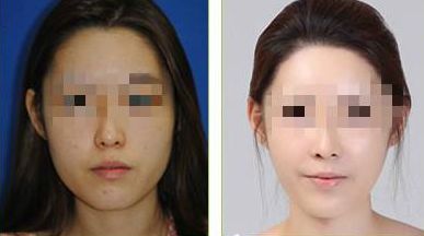 協(xié)和醫(yī)院張海林隆鼻效果評價