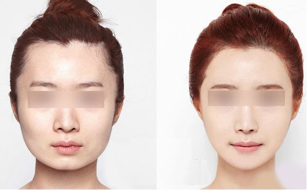 北京線雕祛痘坑醫(yī)院排行榜：十家口碑好效果佳的精選