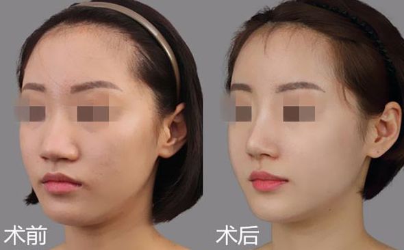 保定祛痘疤口碑前十整形醫(yī)院排名及價格對比