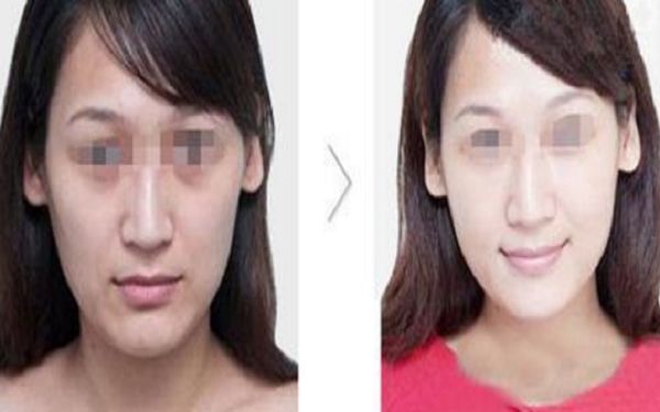 鄭州雀斑治療醫(yī)院排行榜更新！解放雀斑困擾，顏值重回巔峰