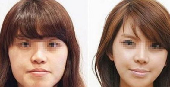 綿陽歪鼻修復(fù)手術(shù)口碑好醫(yī)院前十強(qiáng)排行盤點(diǎn)