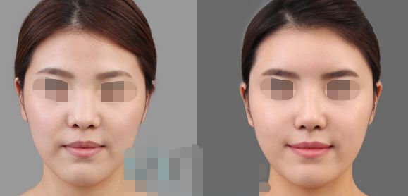 國(guó)內(nèi)隆鼻醫(yī)院排名揭曉！前10家醫(yī)院完美整理，前5&前3，美麗真誠(chéng)推薦！