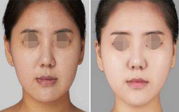 深圳鼻部脂肪填充美容機(jī)構(gòu)排行榜：前10強(qiáng)連鎖名單揭秘！