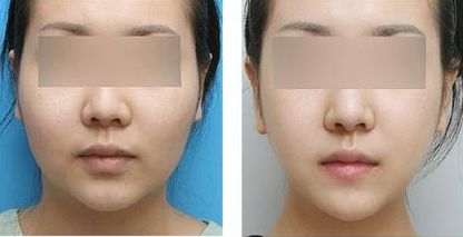 南京FUP微創(chuàng)多點(diǎn)面部提升術(shù)前10大醫(yī)院排行榜公布！