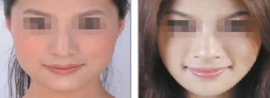 術(shù)后隆鼻假體護(hù)理攻略：如何有效照顧術(shù)后鼻部假體？