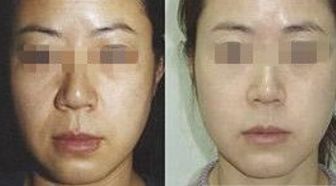 解密汕頭10家口碑爆棚的法令紋光子嫩膚醫(yī)院