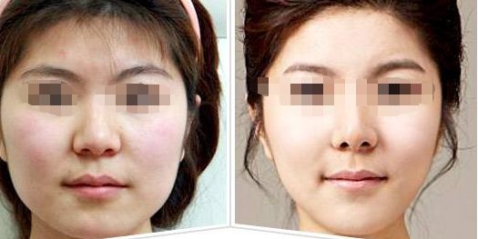 汕頭市中心醫(yī)院汕頭脂肪隆鼻專業(yè)醫(yī)療團(tuán)隊豐富，權(quán)威細(xì)節(jié)請點擊！