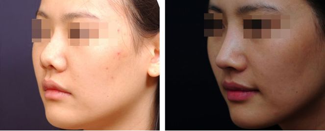 鄭州超皮秒去紋身靠譜醫(yī)院前十評鑒！權(quán)威指南助你煥顏重生