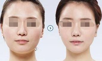 深圳十大口碑豐胸整形醫(yī)院權(quán)威解說