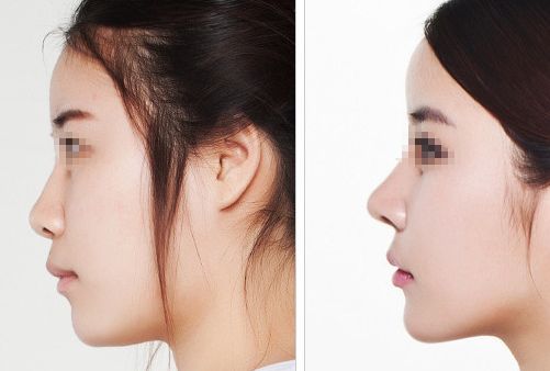 上海拉皮手術(shù)專家排行榜，值得推薦的李青峰、金云波和顧斌等擅長技術(shù)的醫(yī)生！