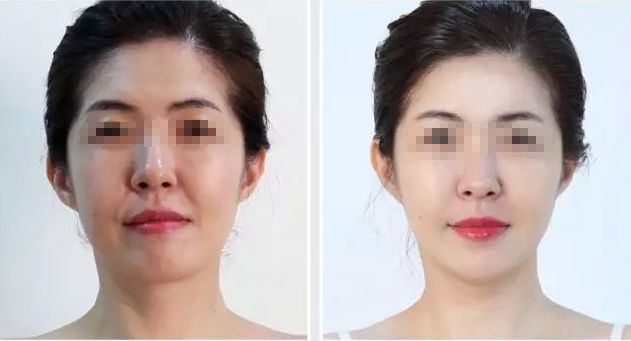 福州華美隆鼻整形效果如何