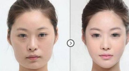 運(yùn)城：上眼瞼嗨體填充，哪家整形醫(yī)院值得信賴？