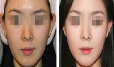 中山市去眼周細(xì)紋手術(shù)靠譜醫(yī)院榜單，口碑真實(shí)參考