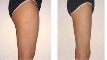 西安哪家整容醫(yī)院的隆鼻效果比較好呢？