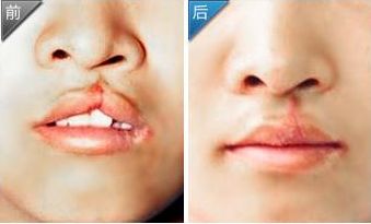 邢臺(tái)尚美醫(yī)療美容：專業(yè)的脂肪隆鼻醫(yī)院服務(wù)詳解！