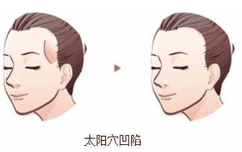 長(zhǎng)沙哪家整形醫(yī)院做隆鼻技術(shù)好？湖南人民醫(yī)院實(shí)力醫(yī)生坐診質(zhì)量咋樣？