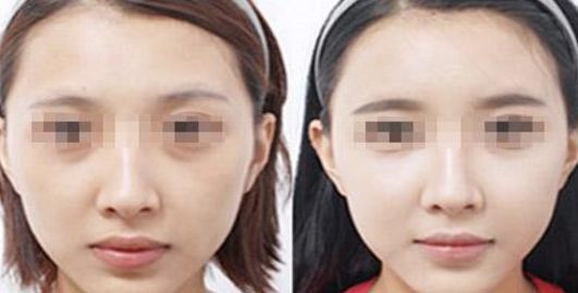 無錫消除深度皺紋術(shù)10佳醫(yī)院排行及技術(shù)分析