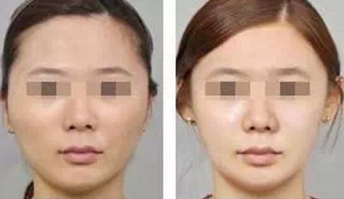 長(zhǎng)春市哪家醫(yī)院牌子好的植發(fā)手術(shù)效果可靠