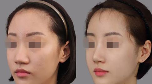 2023年更受歡迎的隆胸專家排行榜揭曉！這五位醫(yī)生技術(shù)高超，深受大眾喜愛！