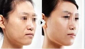 【上海娜美醫(yī)療美容】程旭醫(yī)生隆胸效果如何？委托的醫(yī)院有哪些？