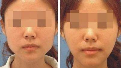 【持續(xù)關(guān)注】成都潤美玉之光隆胸效果如何？真實(shí)用戶分享體驗(yàn)