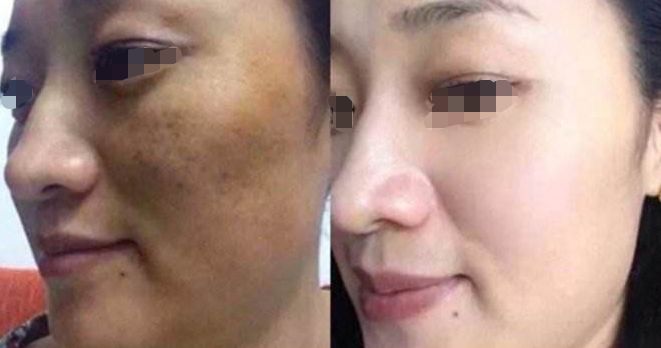 衡陽(yáng)干細(xì)胞祛淚溝整形，10家醫(yī)院技術(shù)領(lǐng)先，實(shí)力大比拼