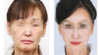 長沙微針祛眼底紋：專業(yè)機構(gòu)實力大比拼！