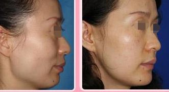 沈陽眼瞼懸吊術(shù)，哪家醫(yī)院口碑好？看看這十佳榜單