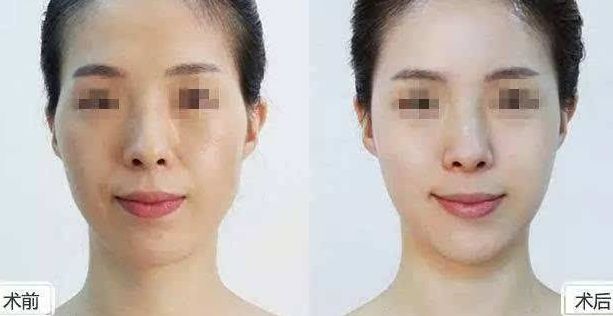 優(yōu)質(zhì)寧波眼角紋線雕美容醫(yī)院推薦：這份榜單不容錯過