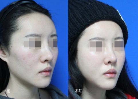 北京哪家醫(yī)院的隆胸效果比較好？