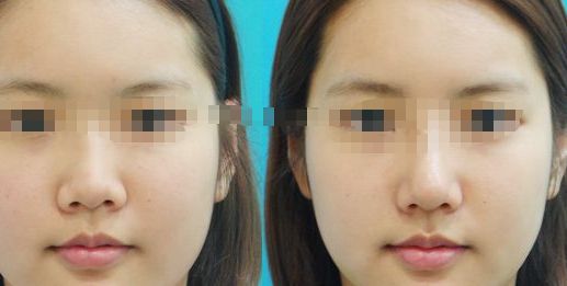 煙臺唇紋凹陷填充，權(quán)威醫(yī)院推薦清單