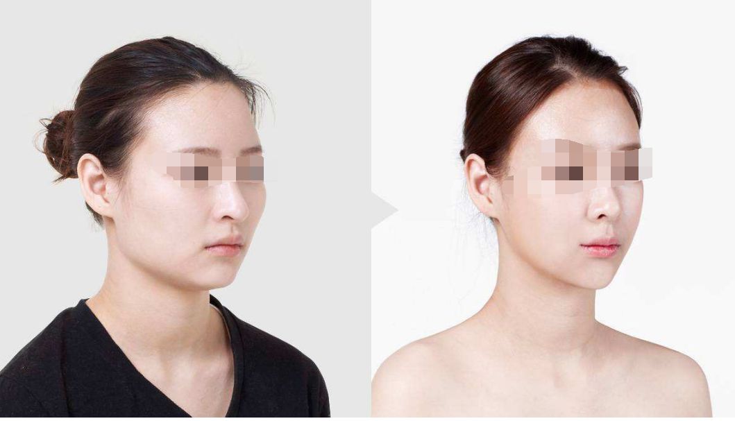 亳州眼周熱瑪吉祛皺紋醫(yī)院排名前十口碑盤點