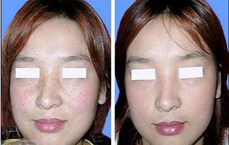 沈陽(yáng)口碑前十好去處：高效去紋身，重塑無(wú)痕新肌