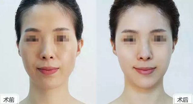 華西醫(yī)院岑瑛隆胸效果怎樣？