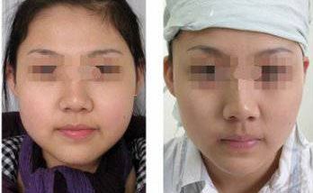 深圳鼻基底耳軟骨填充醫(yī)院口碑排行榜，前十強(qiáng)揭曉！