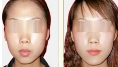 無錫木偶紋微整形整形醫(yī)院排名前10強(qiáng)榜單大揭秘