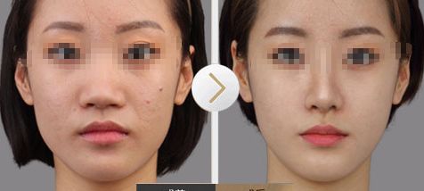 泉州玻尿酸填充印第安紋，這10家醫(yī)院實(shí)力在線(xiàn)！