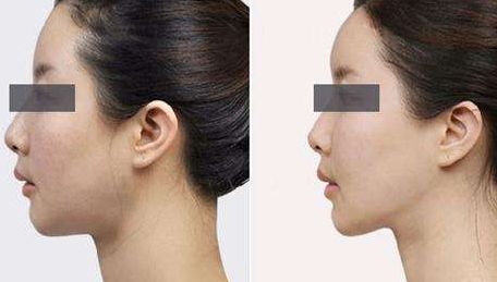 上海離子負(fù)壓祛眼袋整形良心醫(yī)院推薦