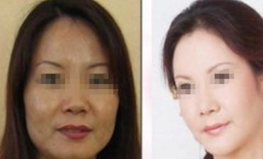 唐志榮教你輕松實(shí)現(xiàn)理想隆胸，還擅長眼鼻整形