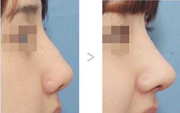 上海激光去靜態(tài)紋哪家好？這十家醫(yī)院口口相傳！