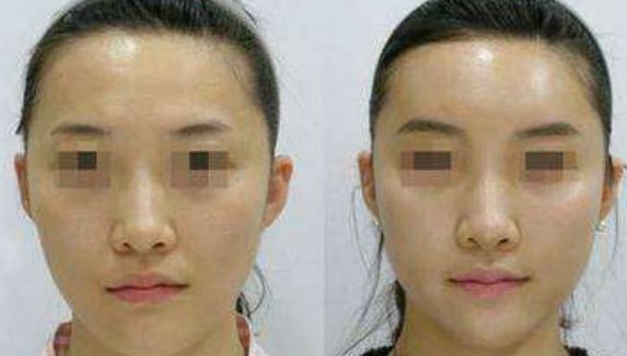 成都脂肪填充眉骨受歡迎的十大醫(yī)院推薦