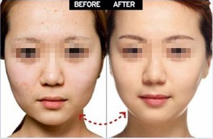 長沙痘痕磨削手術醫(yī)院推薦：專業(yè)評價前十家