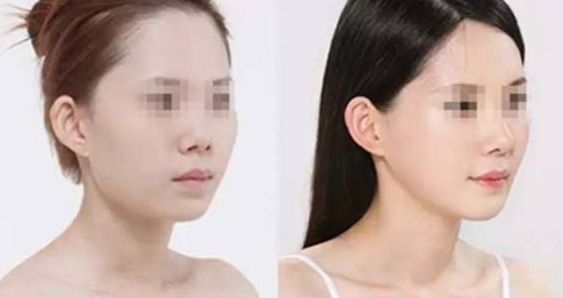 廣州微創(chuàng)整形醫(yī)院排名解析：小切口技術(shù)細說，評選揭曉