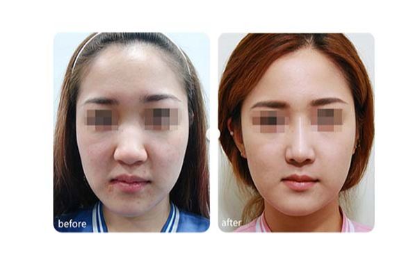 太原隆鼻尖整形美容醫(yī)院排名前十強(qiáng)！同城精選，助你找到最合適的醫(yī)院！