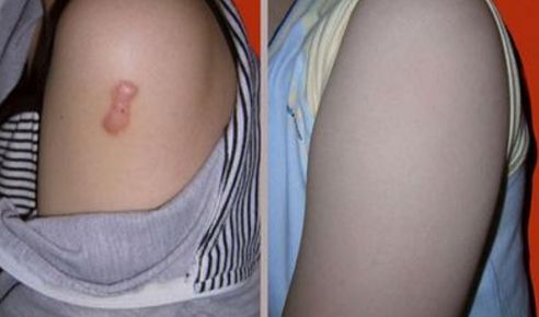 廣州隆胸的譚新東醫(yī)生技術(shù)專業(yè)可靠嗎？