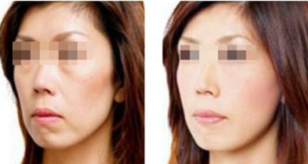 寧波權(quán)威整形醫(yī)院推薦：激光祛疤效果卓越