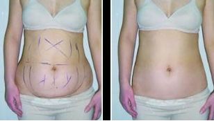 煙臺靜態(tài)紋去除哪家整形醫(yī)院口碑最佳？Top10排名揭曉