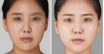 成都美萊假體隆胸的效果怎么樣？- 醫(yī)院整形技術(shù)高超，讓您滿意