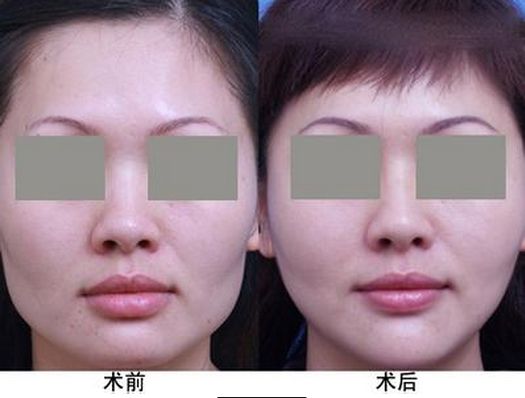 西安光電去除淚溝正規(guī)整形醫(yī)院排行榜揭秘！