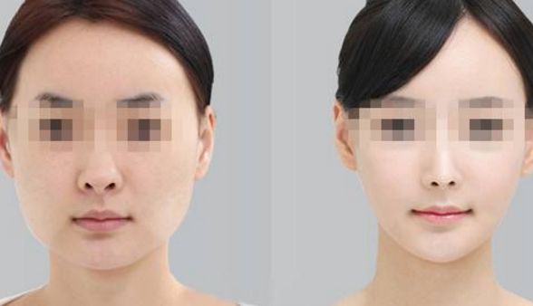 洛陽哪家整形醫(yī)院射頻祛除抬頭紋效果好？前十強醫(yī)院推薦！